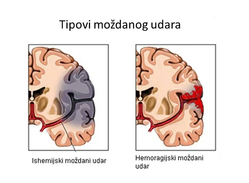 29. октобар - Свјетски дан борбе против можданог удара